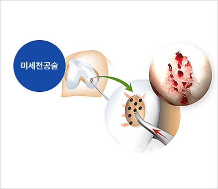 미세천공술