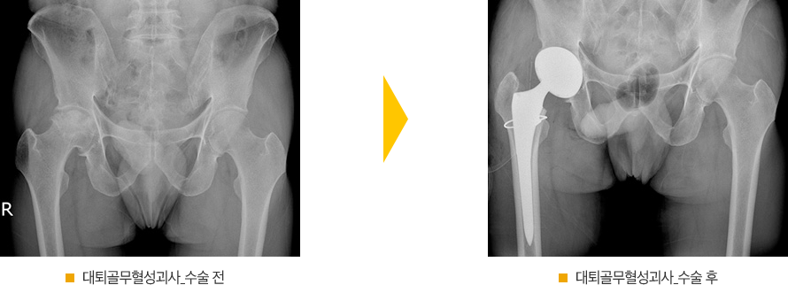 수술 전 후 방사선 사진