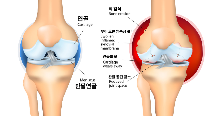 일반 연골과 류마티스 관절염에 걸린 연골 비교사진