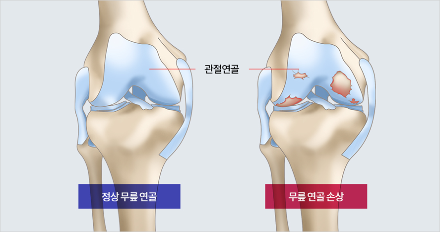 정상 연골과 손상된 연골 비교