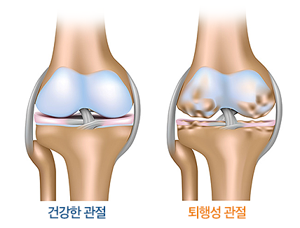 건강한 관절과 퇴행성 관절