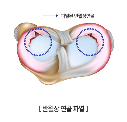 반월상 연골 파열