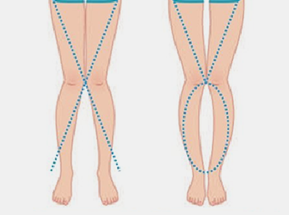 휜다리 증상의 종류 - 외반슬