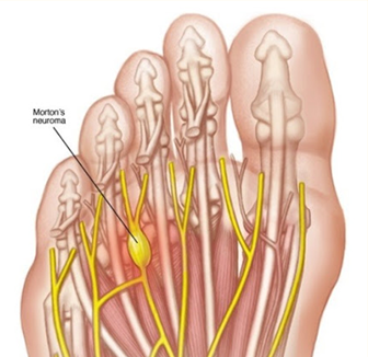 발가락 지간 신경종의 증상