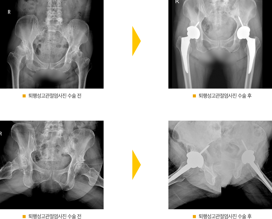 수술 전 후 방사선 사진