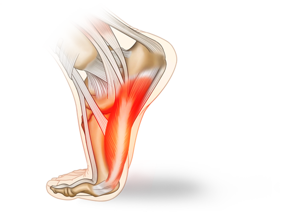 족저근막염의 증상